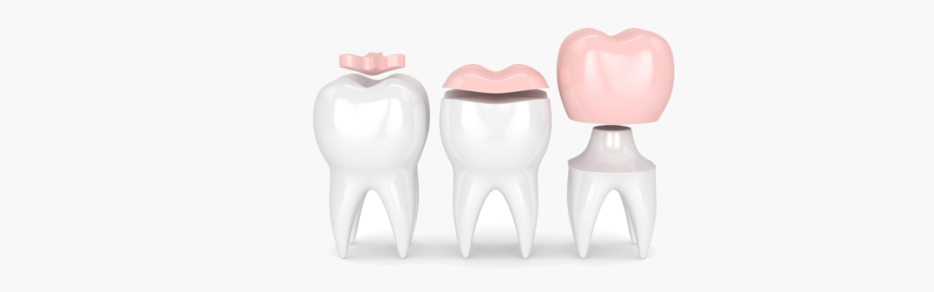 Everything You Need to Know About Dental Inlays and Onlays