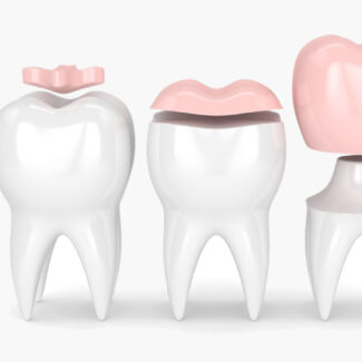 Everything You Need to Know About Dental Inlays and Onlays