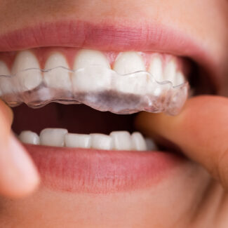 Invisalign: Clear Aligners