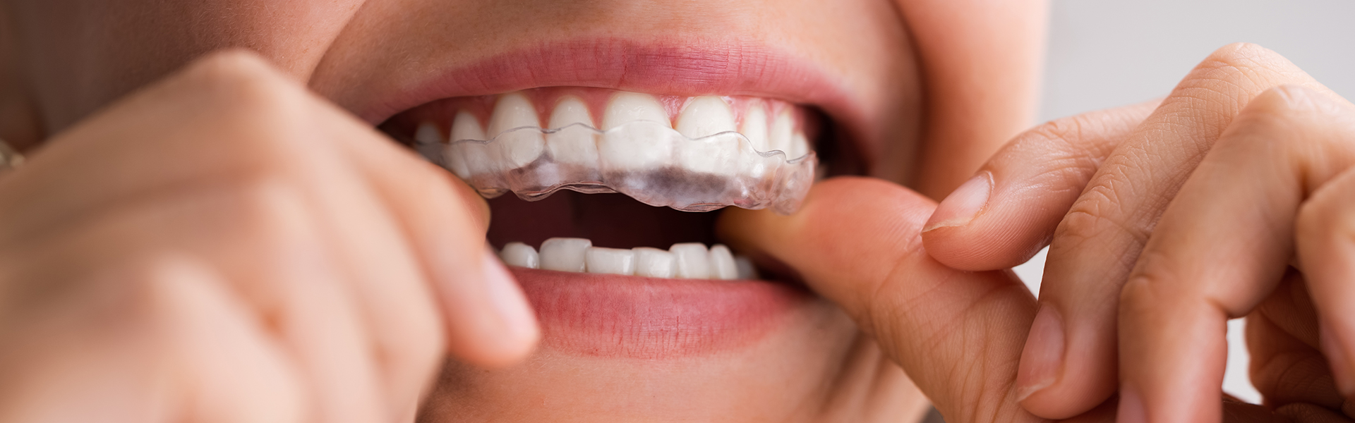 Invisalign: Clear Aligners