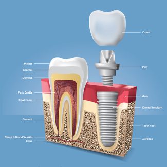 Dental Implants After Tooth Loss