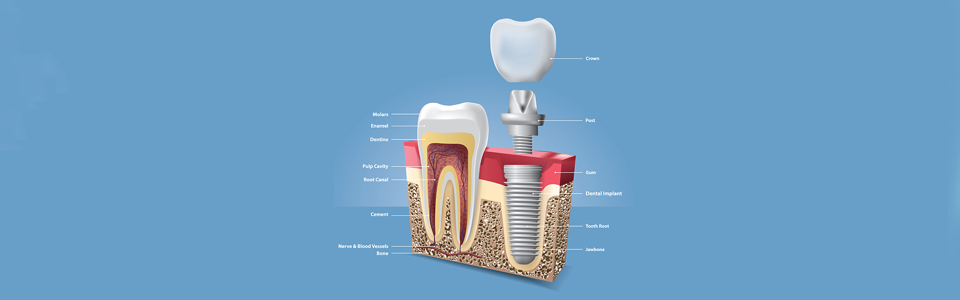 Dental Implants After Tooth Loss